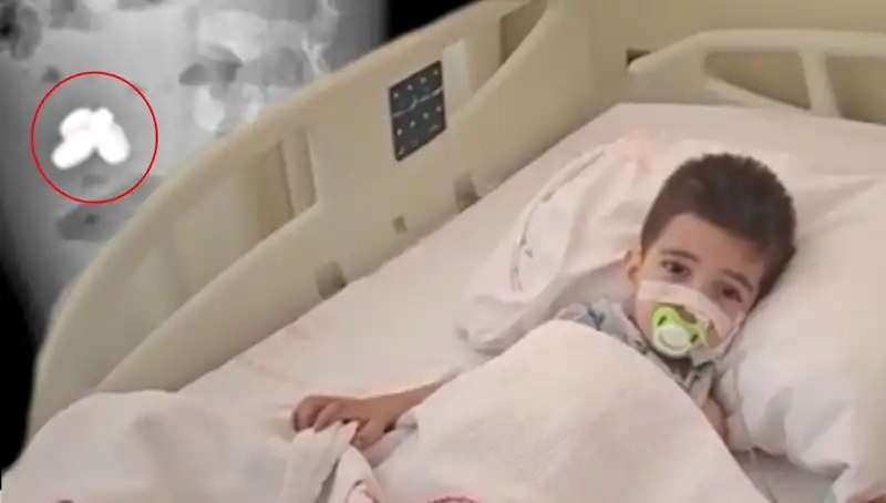 Küçük Çocuğun Hayatını Karanlığa Saran Tehlike: Pil ve Mıknatıs Yuttuktan Sonra Bağırsağında Yangın!